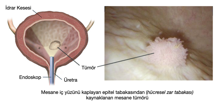 Şekil-2: Mesanedeki tümörün endoskopik görüntüsü genellikle bu şekildedir.