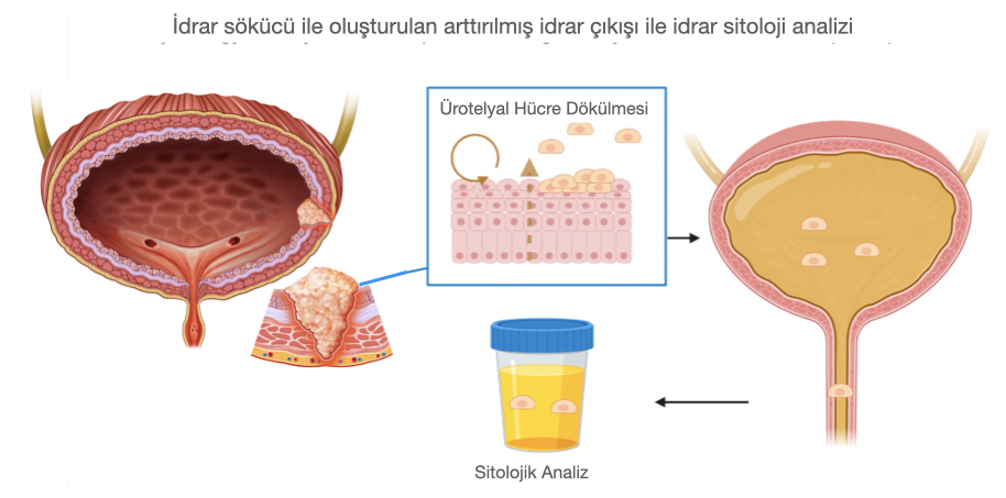 Şekil-3a: İdrarda tümörden idrara dökülen tümör hücrelerinin boyanıp mikroskobik olarak incelenmesine sitoloji denilmektedir.
