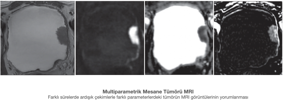 Şekil-4: Multiparametrik MRI de mesanedeki kitlenin ve kanlanma özelliklerinin ardışık görüntülenmesi.