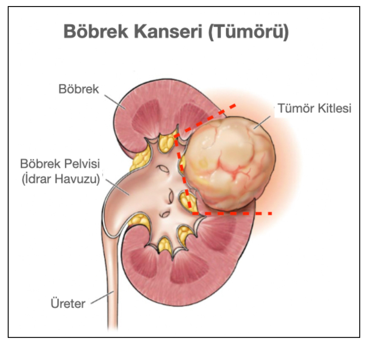 Şekil-9: Robotik cerrahi ile böbrek kanseri kitlesinin normal böbrek bölümü korunarak kırmızı çizgilerin olduğu sınırdan çıkartılması. Robotik Parsiyel Nefrektomi ya da Robotik Nefron-koruyucu Tümör Eksizyonu