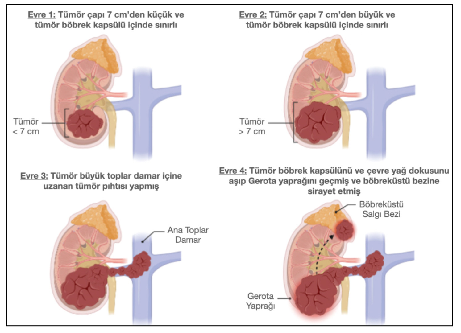 Şekil-8: Böbrek Kanseri evreleri