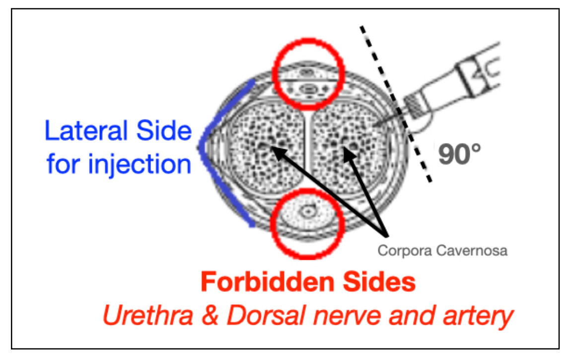 Figure 8: Use lateral side of the penis for injection