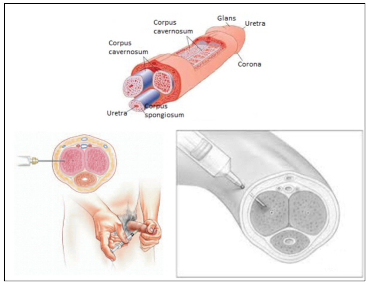 Figure 7: The erectile (spongy) tissue responsible for erection is called the corpus cavernosum. The needle must be inserted perpendicularly into this tissue through the right or left lateral wall of the penis. The dorsal (upper) side of the penis contains blood vessels and nerves and should never be injected to avoid injury. The ventral (lower) side contains the urethra (urinary canal) and must also not be injected, as it may cause urethral injury. The injection must be made through the right or left side wall of the penis.