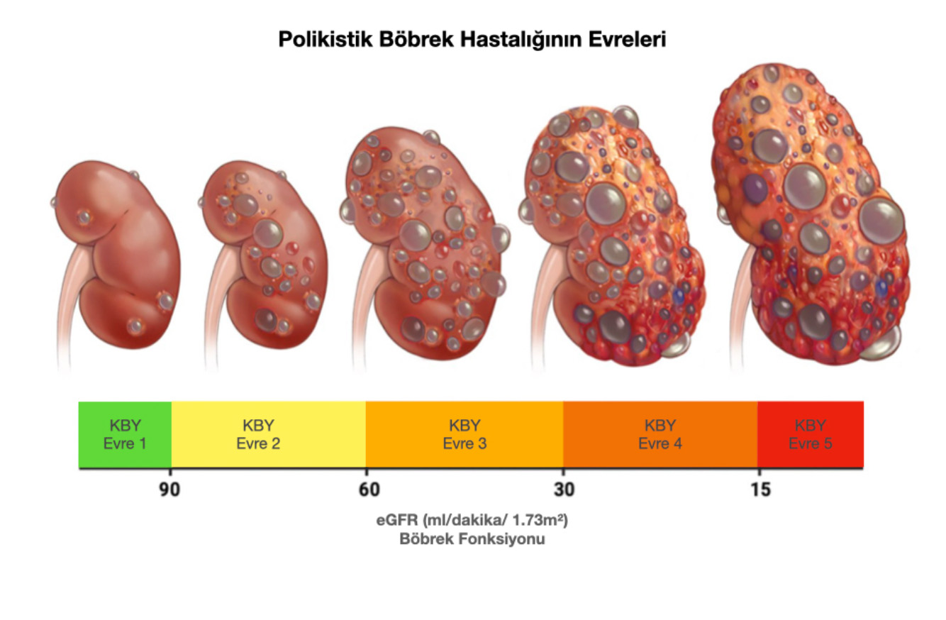 Şekil-8: Böbrek fonksiyonunun şiddetine göre polikistik böbrek evrelenebilir.