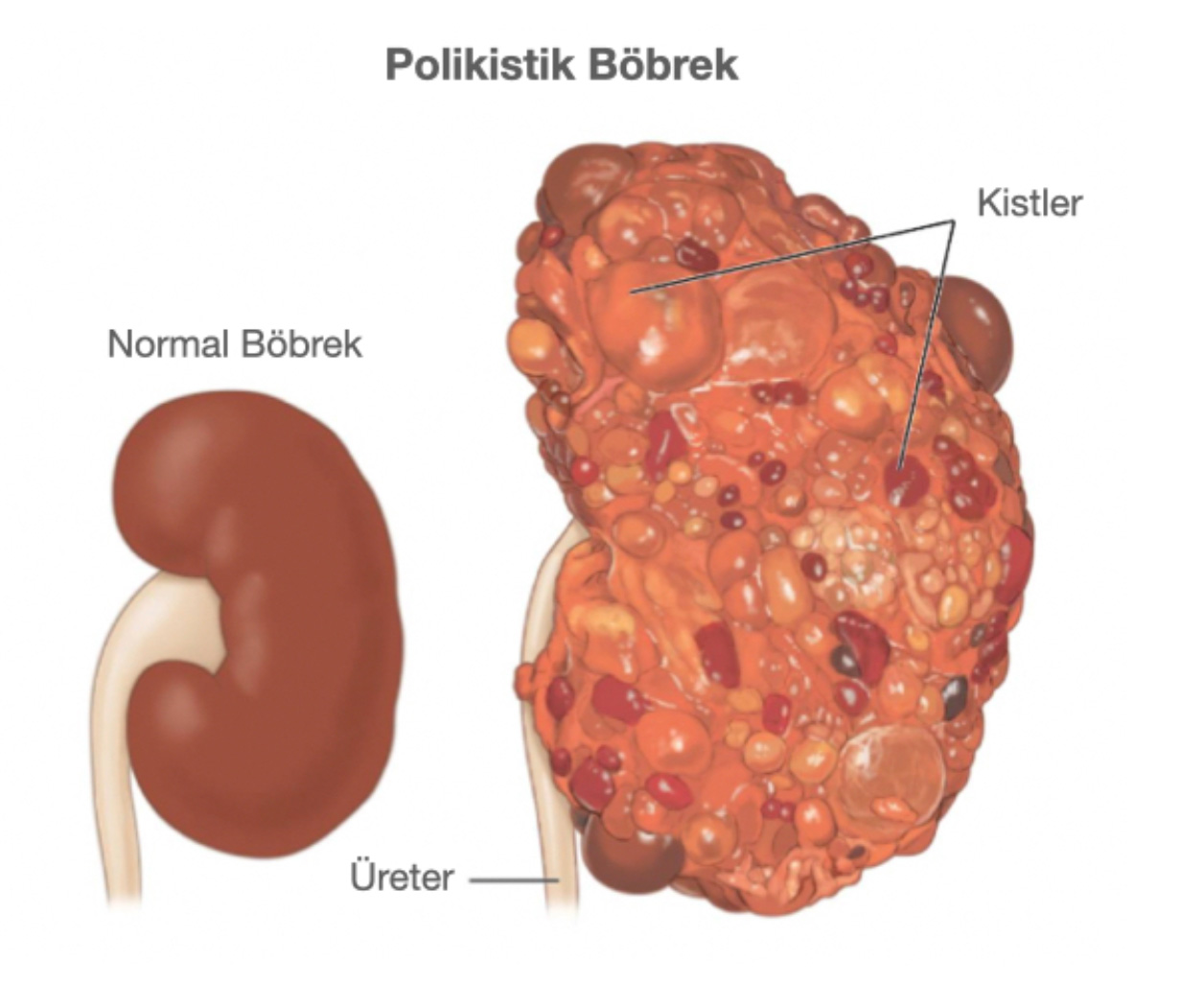 Şekil-6: Normal böbrek ve polikistik böbrek