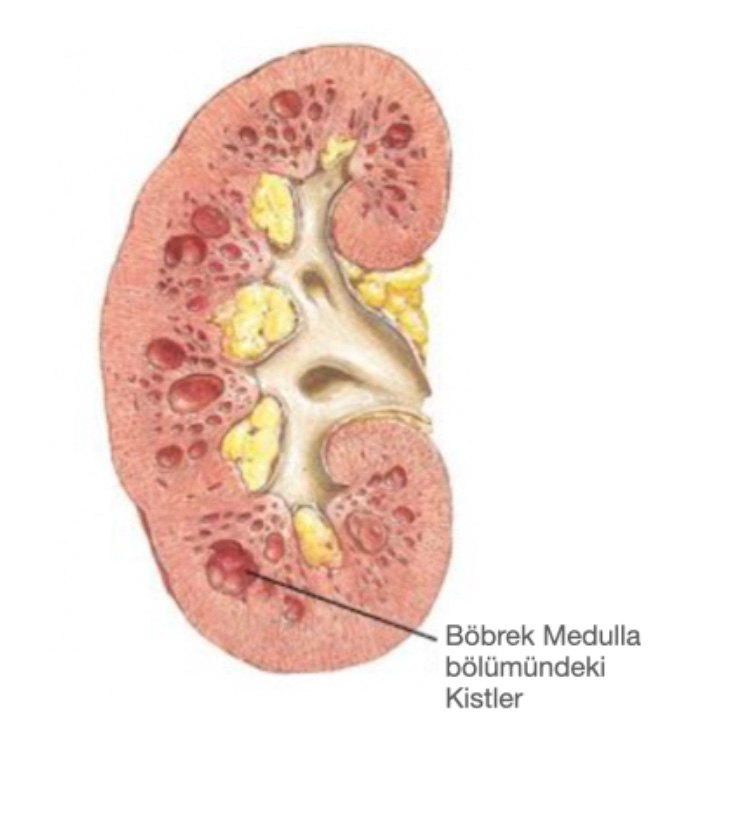 Şekil-10: Medüller sünger böbrekte kistler böbreğin medulla kısmı olan ortaya yakın kısmında kümeleşmektedir.